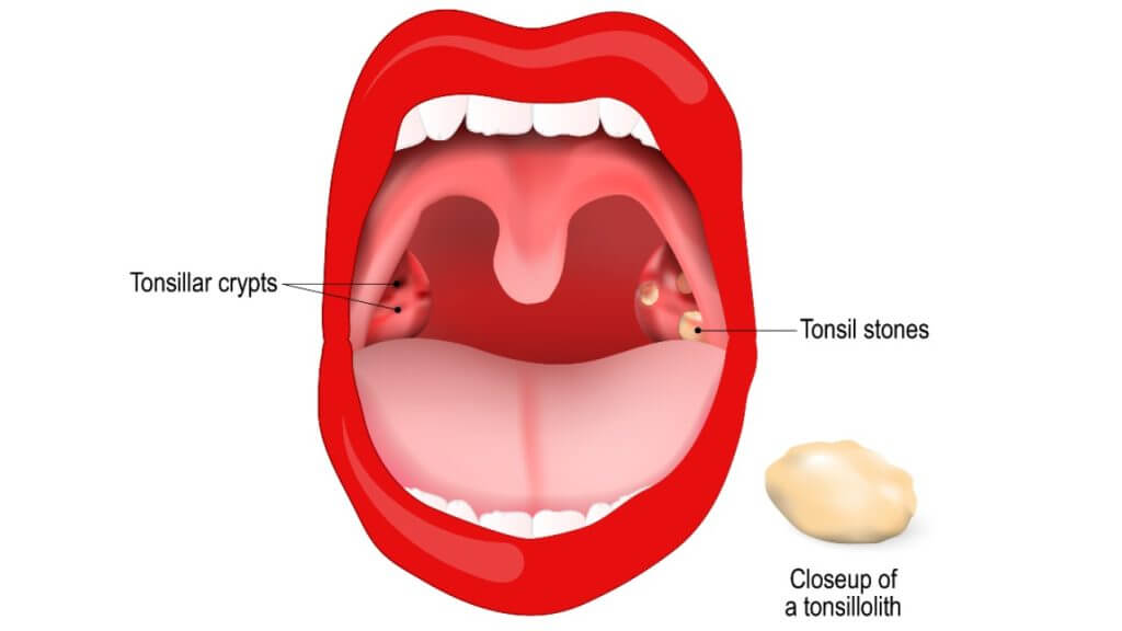 Tonsil Stotes